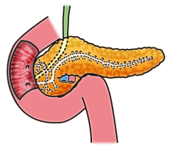 膵臓の主な病気 北村医院